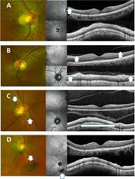This may happen in patients with severe diabetic retinopathy. Acute Symptomatic Vitreous Floaters Assessed With Ultra Wide Field Scanning Laser Ophthalmoscopy And Spectral Domain Optical Coherence Tomography Scientific Reports