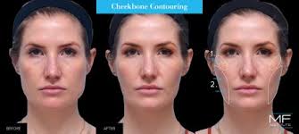 botox for face slimming