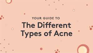 Your Guide To The Different Types Of Acne