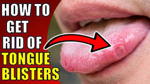 tongue blisters canker sores