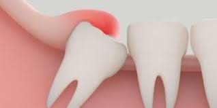 swollen gum tissue around wisdom tooth