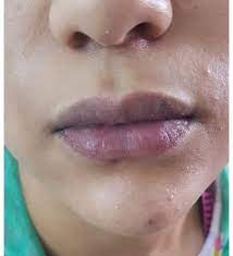 cyanosis on our patient s lips