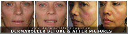 derma roller before after pictures