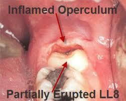 what is pericoronitis