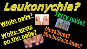 leukonychia whitening of the nails