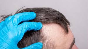 hair loss after bariatric surgery how
