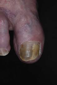 green nail syndrome gns pseudomonas