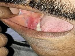 intra herpes and its ayurvedic