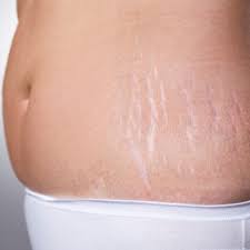 10 tips to reduce your stretch marks