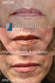lip lines before after photos new
