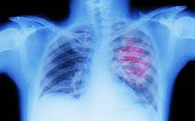 is se 4 lung cancer curable