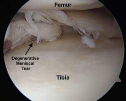 meniscus surgery for complex