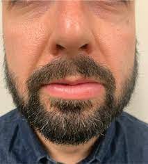 persistent lip swelling mdedge
