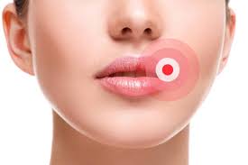 lip fever or cold sores treatment and