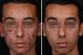 what s the best laser treatment for