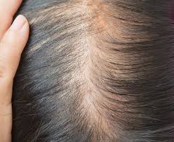 women alopecia hair loss