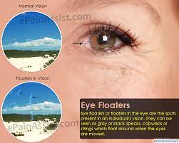 eye floaters what causes floaters in