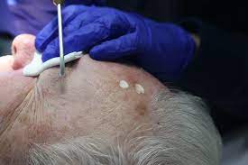 cryotherapy for actinic keratosis