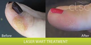 laser wart treatment before and after