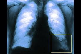 Plicní embolie je život ohrožující onemocnění cévního systému, při němž dochází ke snížení průtoku krve plicním řečištěm. Plicni Embolie Priciny A Lecby