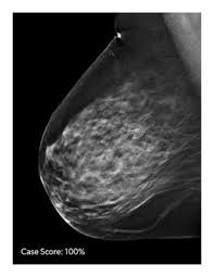 Fda Clears Icads Profound Ai For Digital Breast Tomosynthesis
