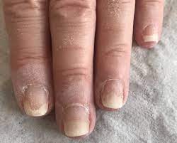 allergic to your gel manicure