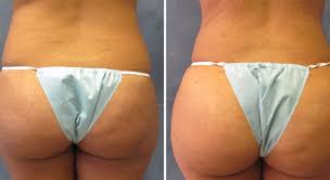 There are many factors that determine the final cost, including the number of liposuction sites involved. Brazilian Butt Lift Houston Dr Nikko Cosmetic Surgery Center