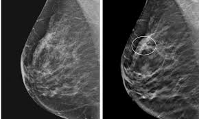 This offers physicians a basic roadmap for navigating the terrain of breast my breast cancer was detected by ultrasound after i had decided to have no more mammograms. Additional Cancer Screening For Women With Dense Breasts Healthcare In Europe Com