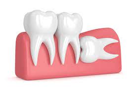relieve wisdom teeth swelling and pain