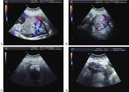 color doppler ultrasound images before