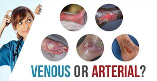 Venous Vs Arterial Ulcers Whats The Difference Wcei