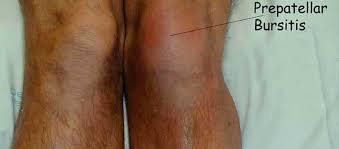 knee bursitis mayfair wellness clinic