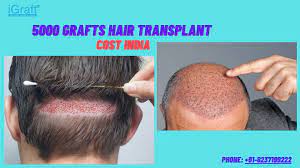 5000 grafts hair transplant cost india