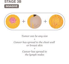 Stage 3 Iii A B And C National Breast Cancer Foundation