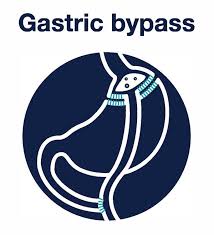 laparoscopic gastric byp