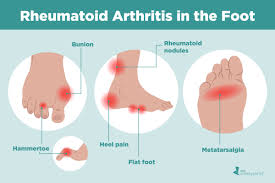The lower end of the leg of a chair or table. Rheumatoid Arthritis In The Feet Symptoms And Treatments