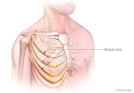 To maximize the level to indicate or conclude that stretched due to swelling is actually lifting. Helping Elderly Patients With Rib Fractures Avoid Serious Respiratory Complications Mayo Clinic