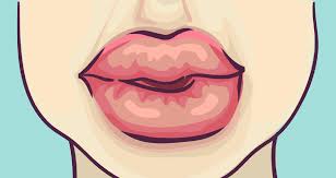 swollen lips allergy symptoms