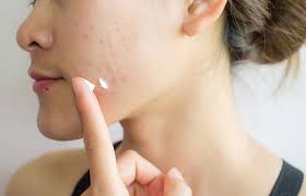 can mederma be used to treat acne scars
