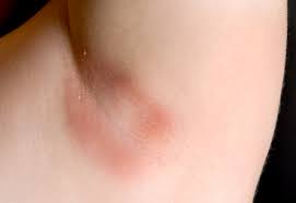 armpit rashes causes treatment and