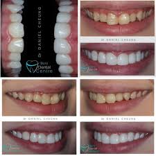 Orthodontics (such as braces) are not covered by most plans, but it is possible to find a dental plan that covers braces. Composite Bonding Bury Dental Centre