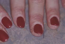 dermais secondary to nail cosmetics