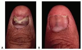 nail matrix repair reconstruction and