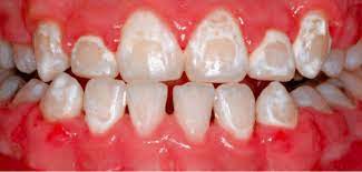 White spots on teeth, marks, patches or stains occur especially after whitening or braces in learn how to get rid of the white spots on your teeth using various treatments, including effective home generally, medical treatments are more reliable and stronger and, are used to get rid of severe white. White Marks On Teeth How To Remove Them Price Review Pictures