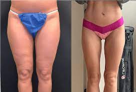 before after thigh liposuction