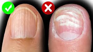 ridges in nails causes of nail ridges