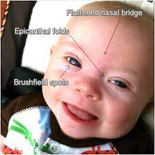 It is a rare condition that affects about 1 in every 2,500 girls. The Bridge On Twitter Down Syndrome