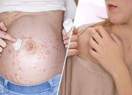 skin rashes during pregnancy try these