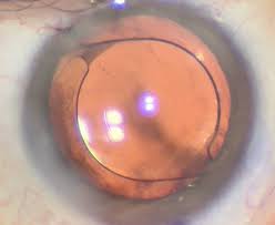 which lens for which patient