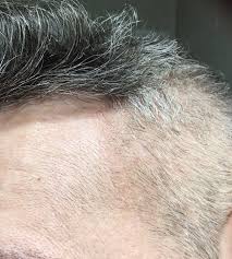Microneedles are microscopic applicators used to deliver vaccines or other drugs across various barriers: Microneedling May 2019 Progress Page 5 Open Hair Loss Topics Hair Restoration Network Community For And By Hair Loss Patients